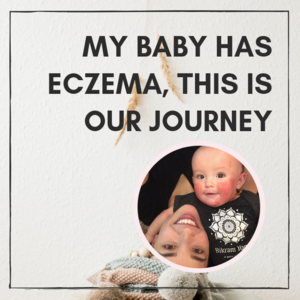 My Baby Has Eczema, This Is Our Journey
